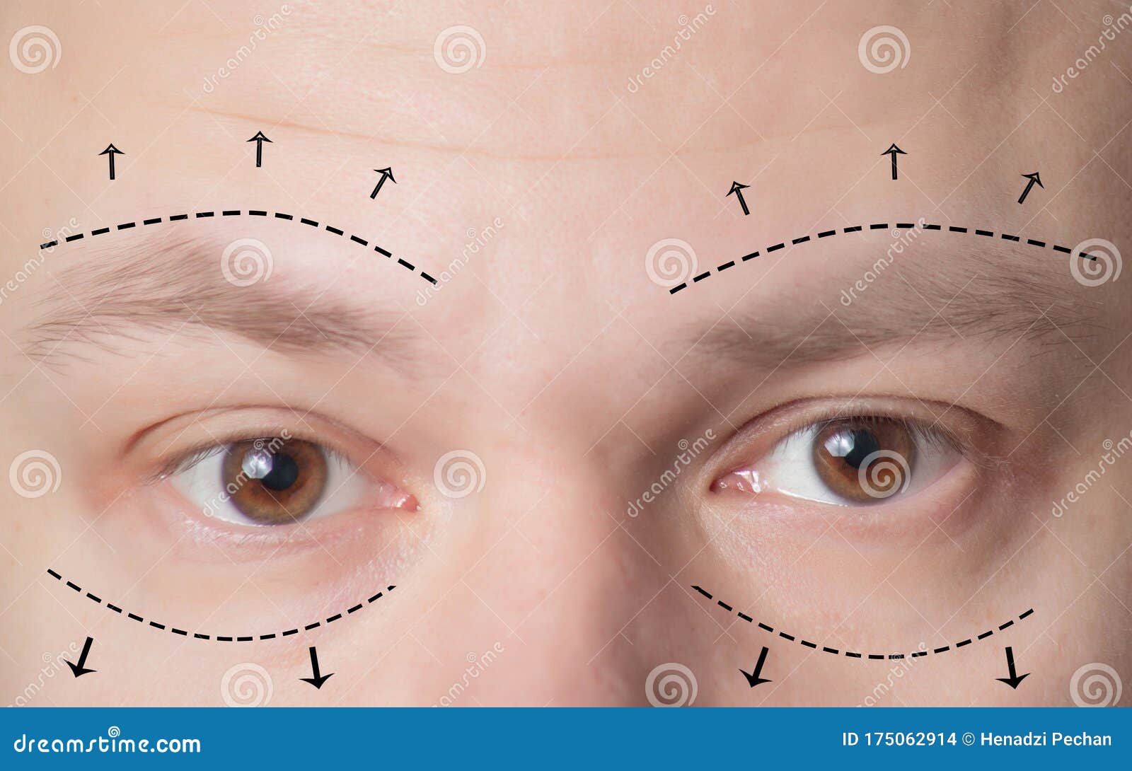 plastic surgery of eyebrows in men, lower and upper eyelids. the concept of the modern blepharoplasty procedure, lifting, close-up