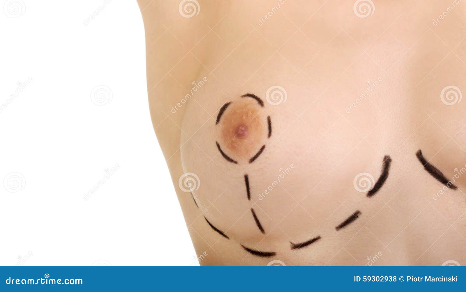 free breast plastic surgery