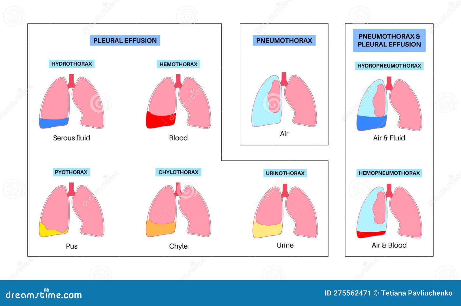 Pleural effusion poster stock illustration. Illustration of pleural ...