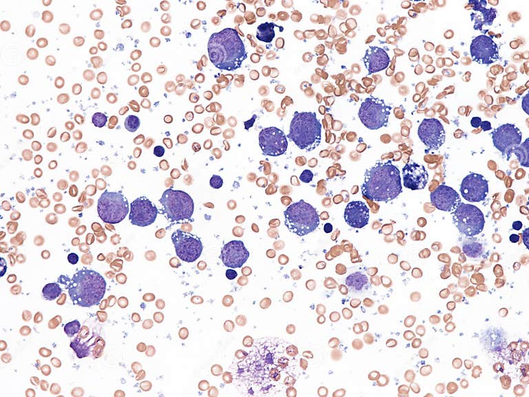 Pleural Lymphoma, Cytology. Stock Photo - Image of large, laboratory ...
