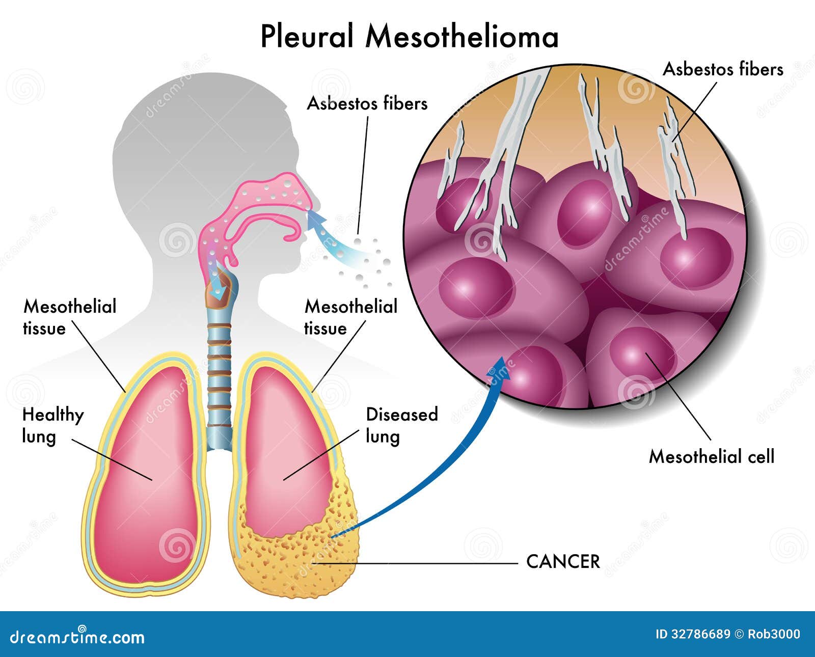 is mesothelioma cancer curable