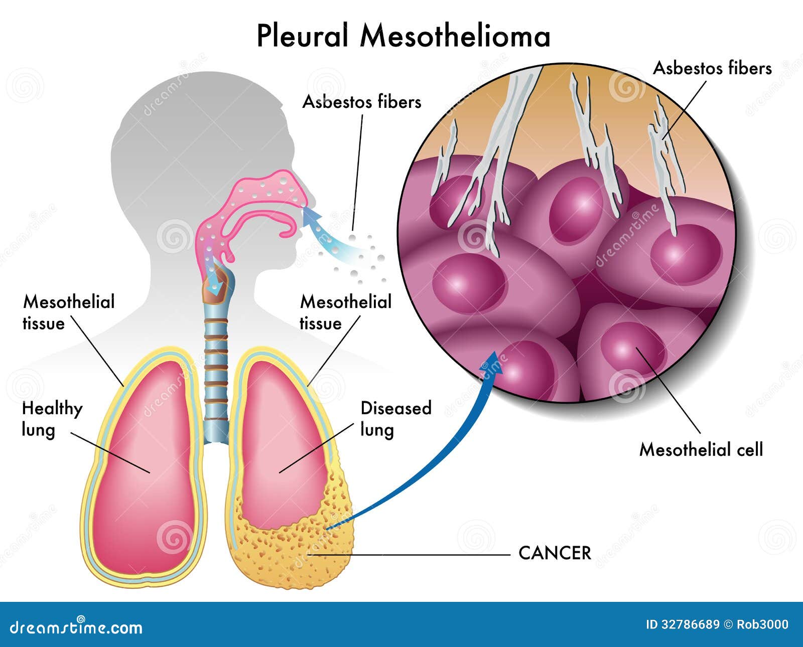 can agent orange cause mesothelioma