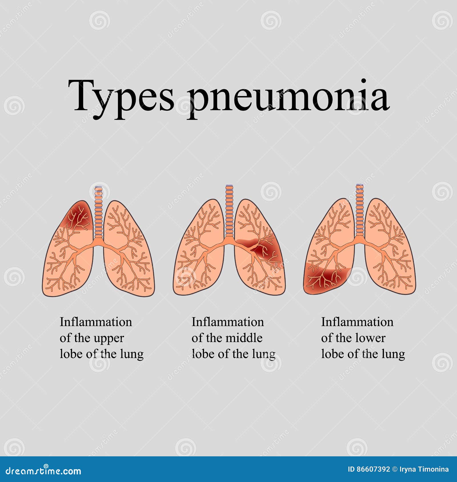 Pneumonia Cartoon Vector | CartoonDealer.com #23933611