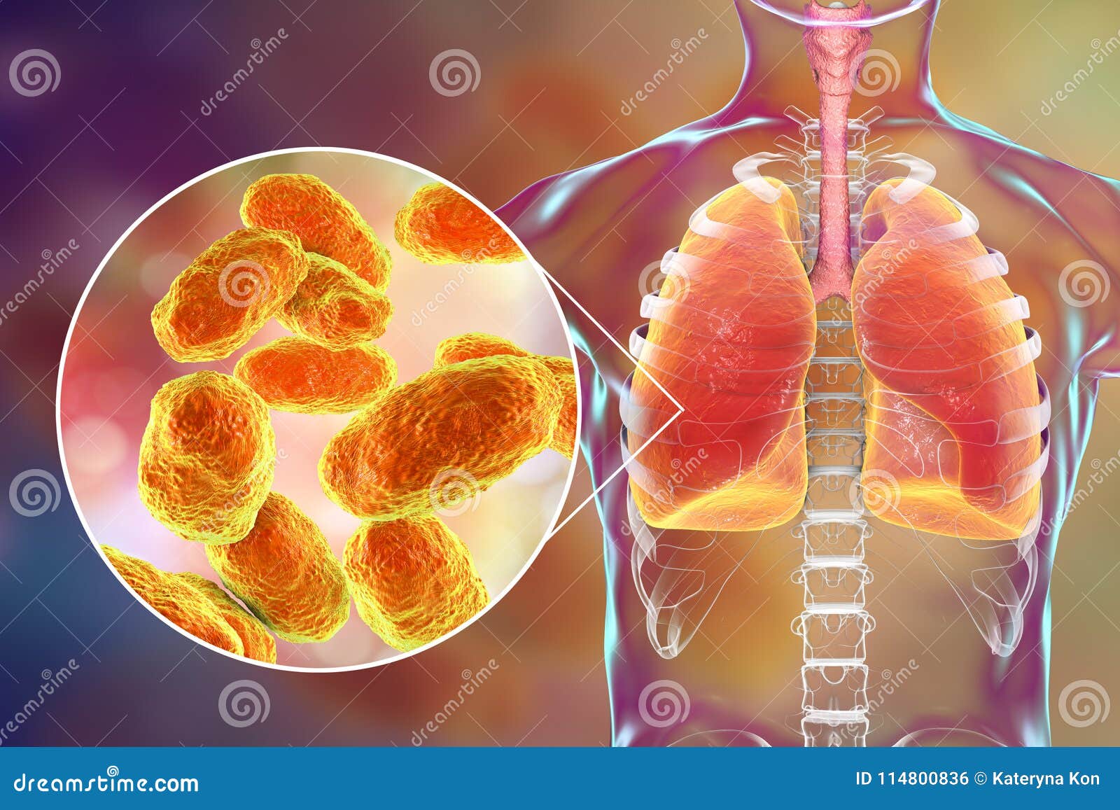 pneumonia caused by haemophilus influenzae bacteria, medical concept