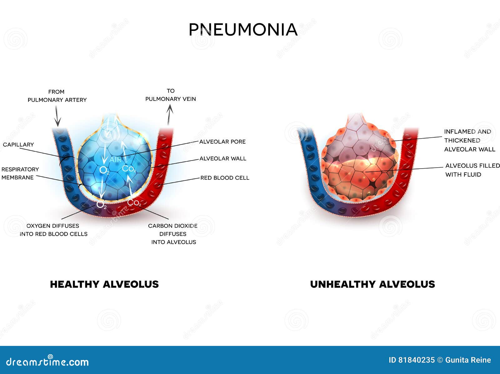 pneumonia and healthy alveoli