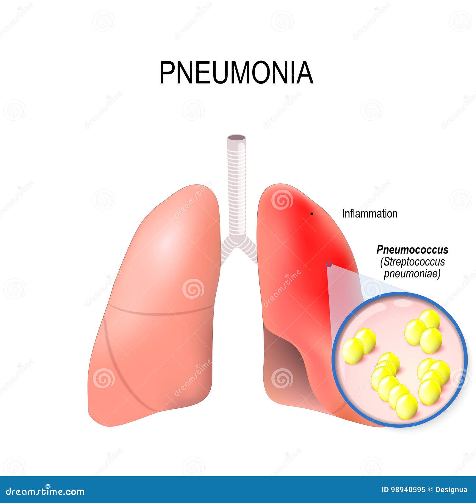 pneumonia. normal and inflammatory condition of the lung.