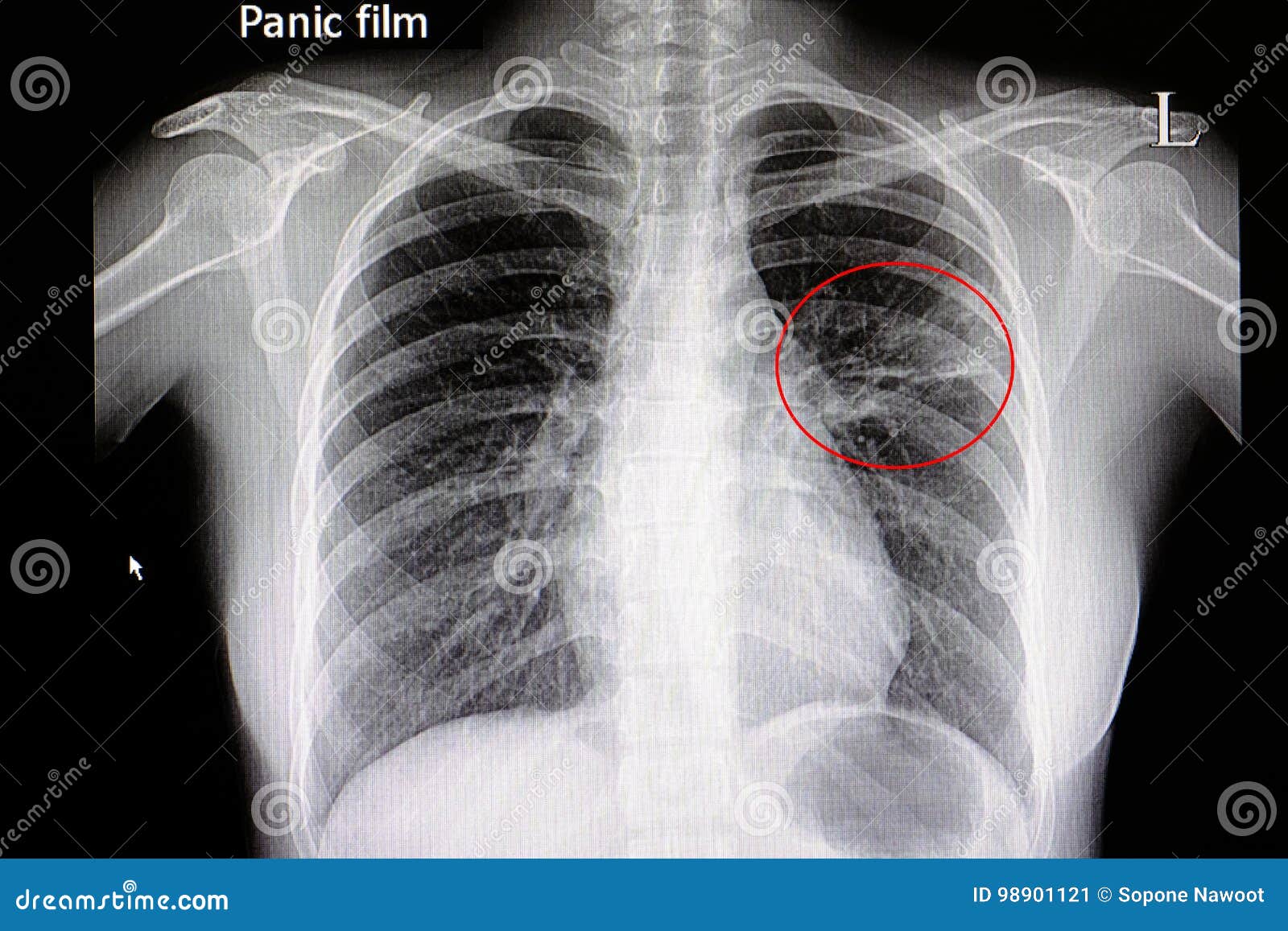 Pneumonia At Left Lower Lung Royalty Free Stock Photography x-0x