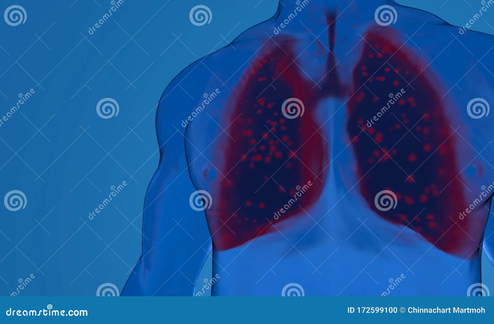 Pneumonie Par Le Virus De La Couronne Dans Les Poumons. Poumon D