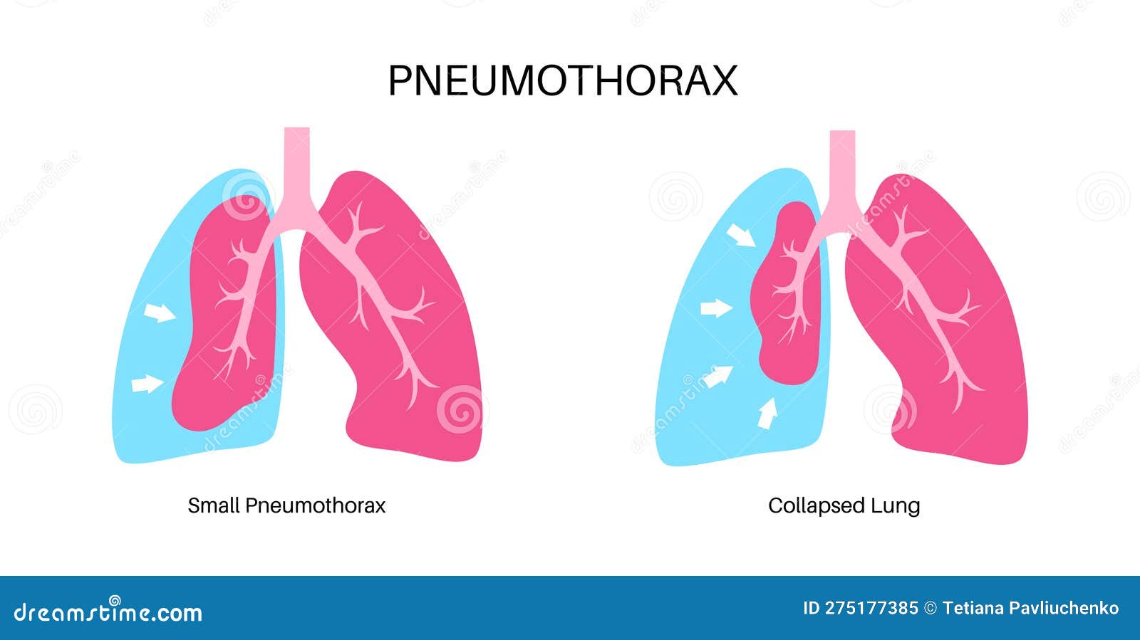 Pneumothorax Anatomical Poster Stock Vector Illustration of pleural