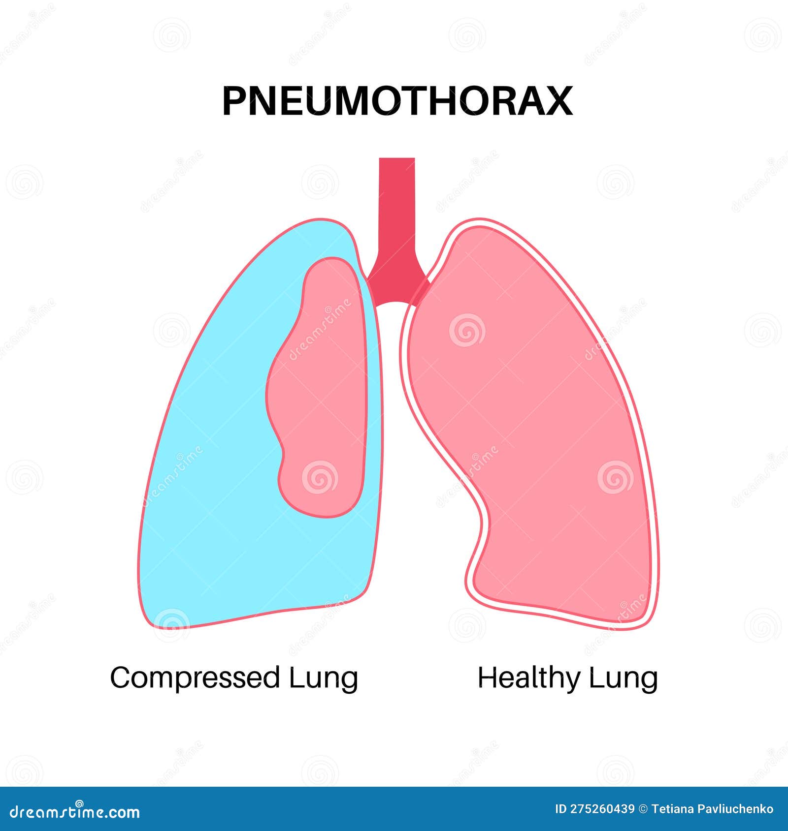 Pneumothorax Anatomical Poster Vector Illustration | CartoonDealer.com ...