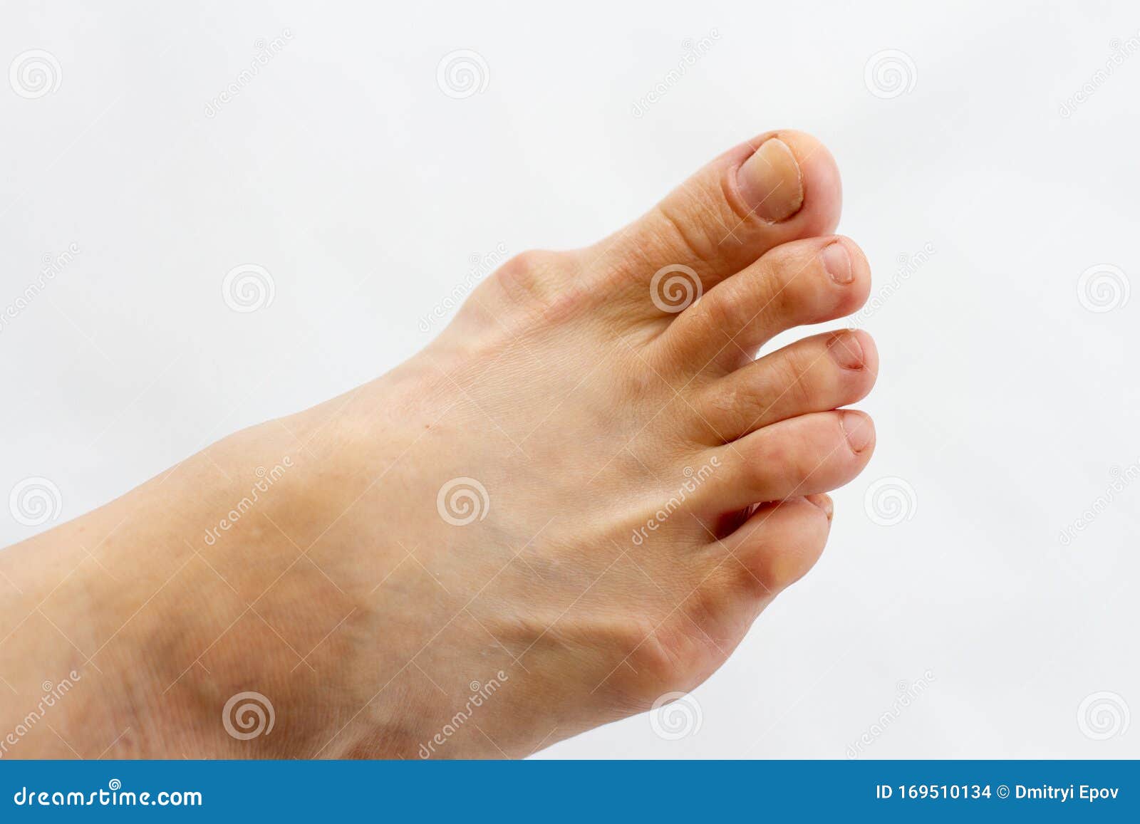 Foot with Gout on the Bones Isolated Stock Photo Image of medicine