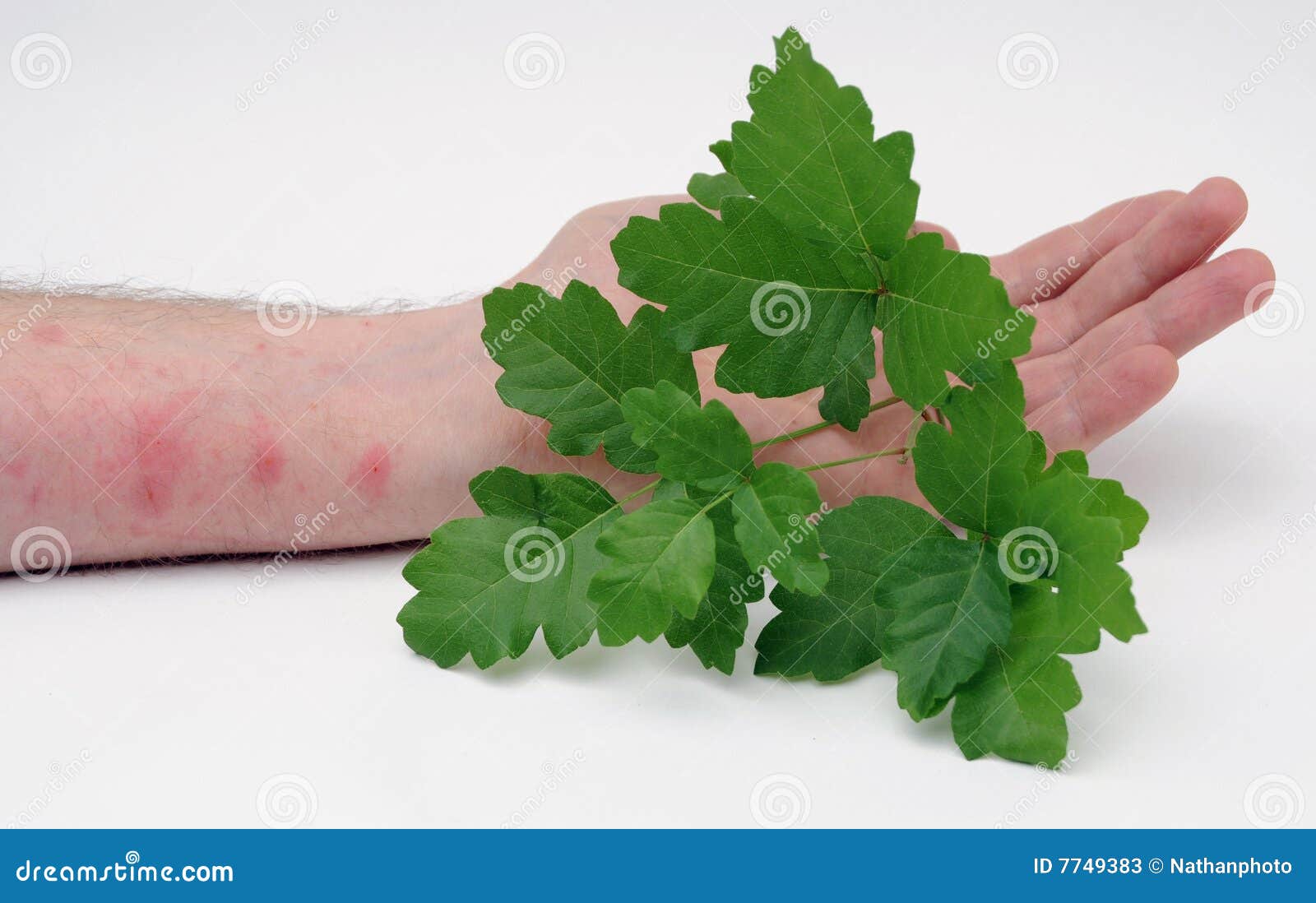 Poison Ivy, Oak And Sumac Rash Treatment, Anne Arundel, 46% OFF