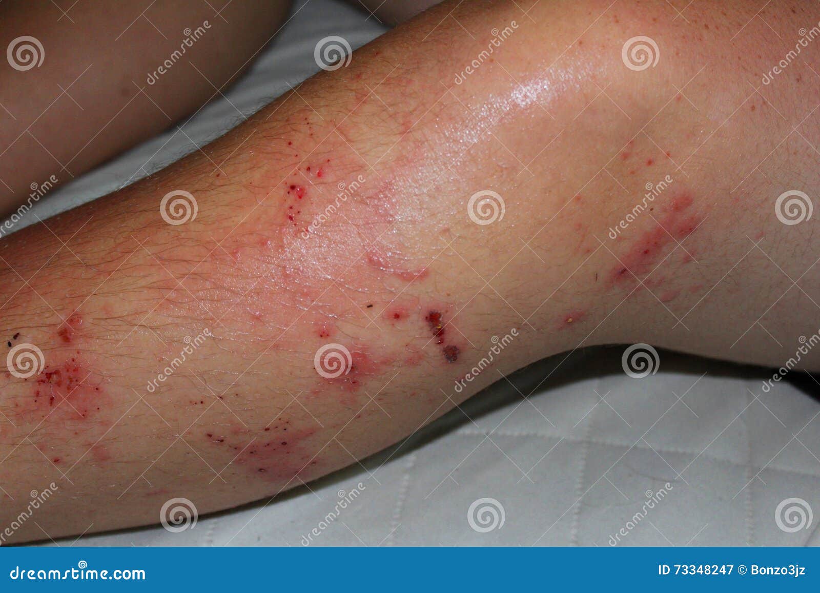 Poison Ivy Rash stock image. Image of dangerous, healthcare 73348247