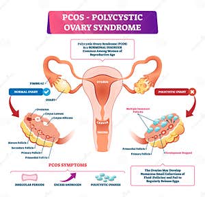 Pcos Clipart And Illustrations