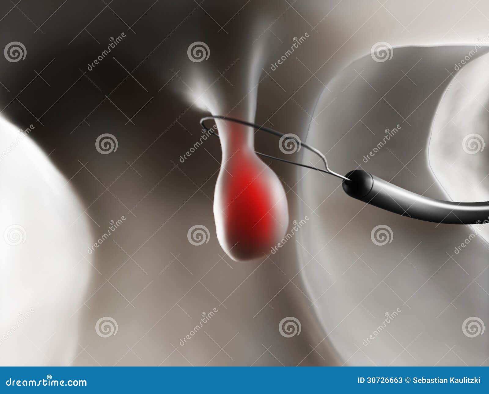 Endoscopic Removal Of Gallbladder Stone Through Mouth, Stomach, To Bile