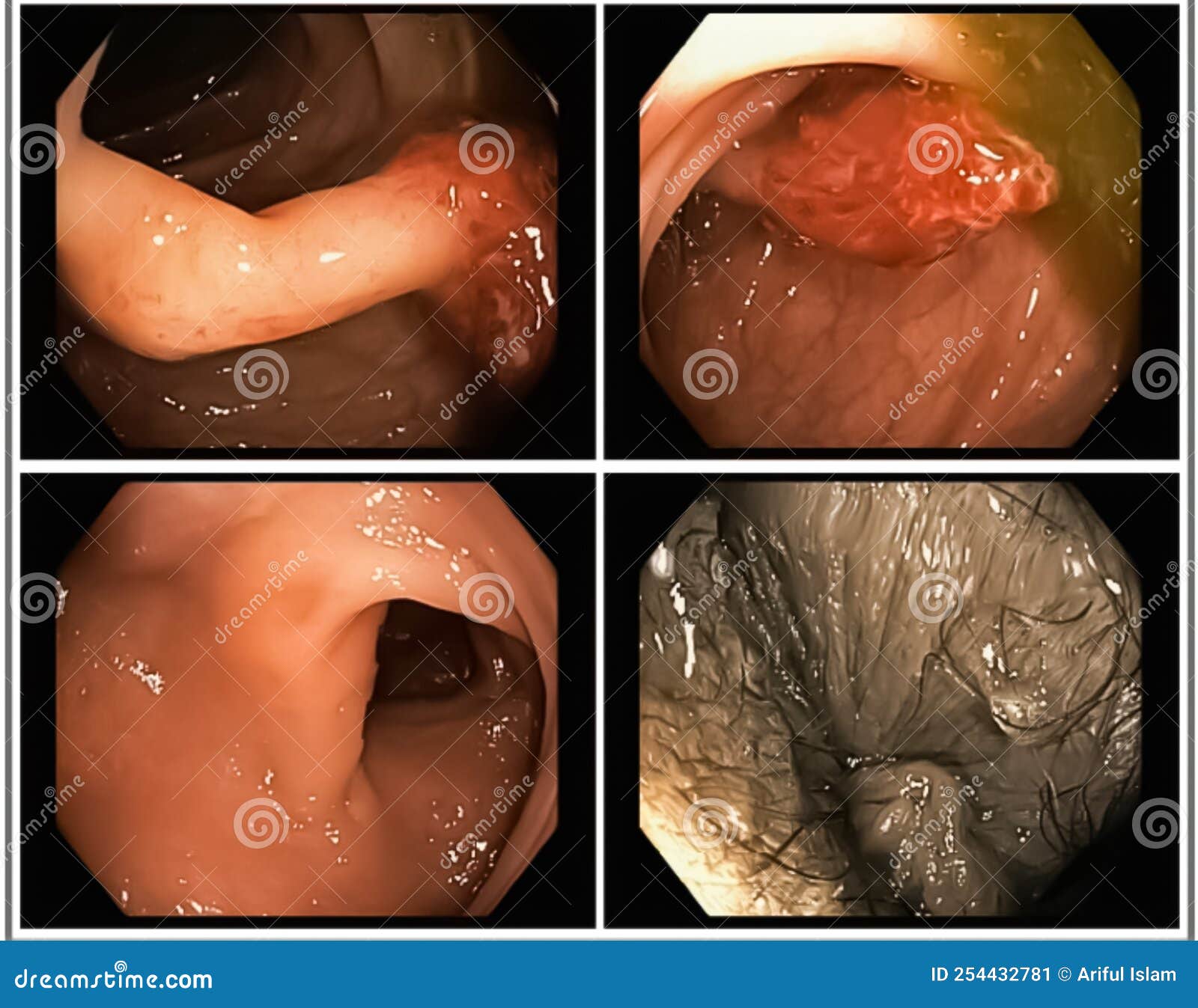 Polype De Colon : Endoscope à L'intérieur De La Coloscopie Pour La ...