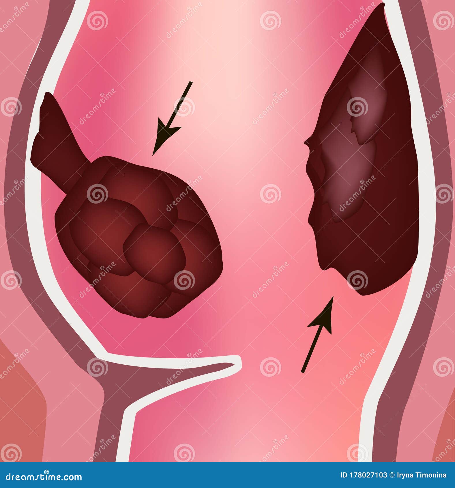 Colon Polyps Cartoon Vector | CartoonDealer.com #28712739