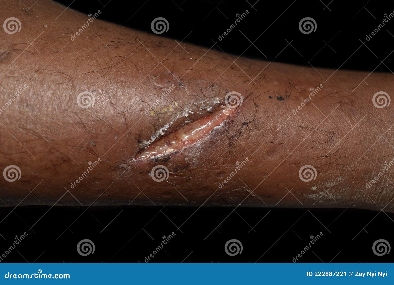 Poor Wound Healing or Secondary Wound Healing with Large Wound Gapping. Wound Infection Stock