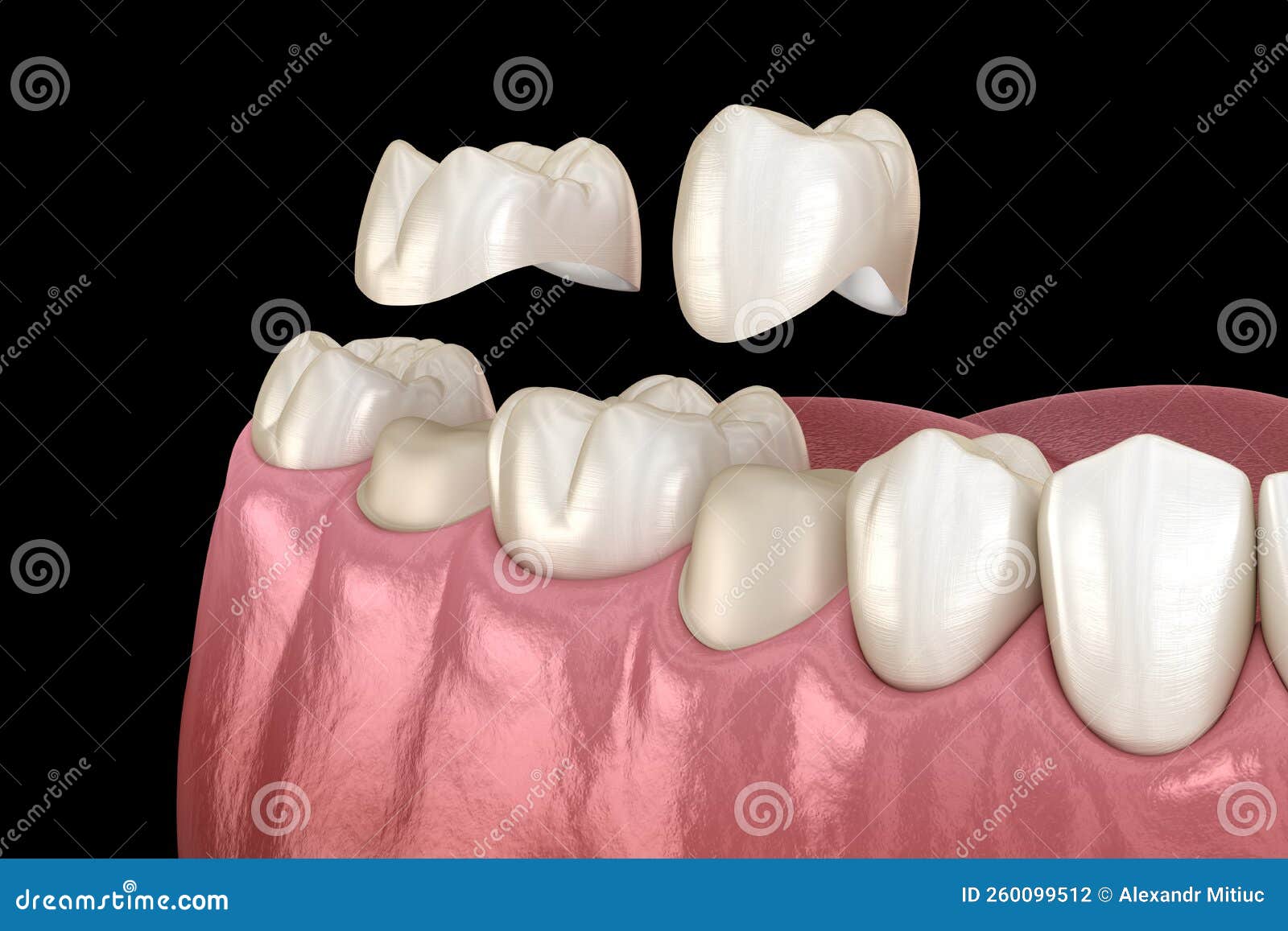 Porcelain Crowns Placement Over Premolar and Molar Teeth. Medically