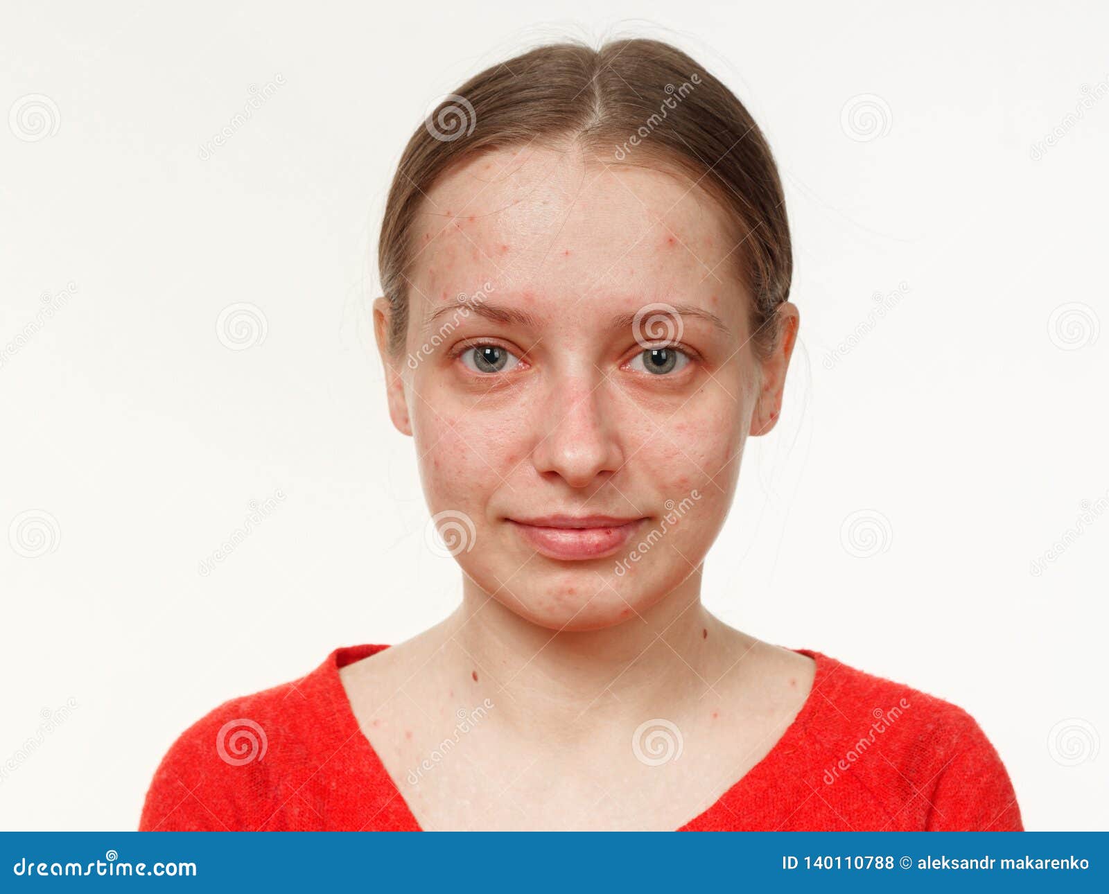 Portrat Eines Madchens Ohne Make Up Akne Auf Dem Gesicht Auf Einem Weissen Hintergrund Stockfoto Bild Von Madchens Akne