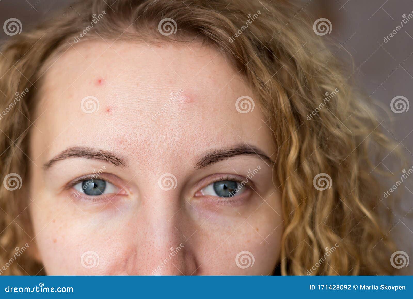 Portrat Der Jungen Schonheit Mit Problematischer Haut Nach Akne Narben Und Rote Eitrige Pickel Auf Dem Gesicht Einer Jungen Frau Stockfoto Bild Von Akne Schonheit