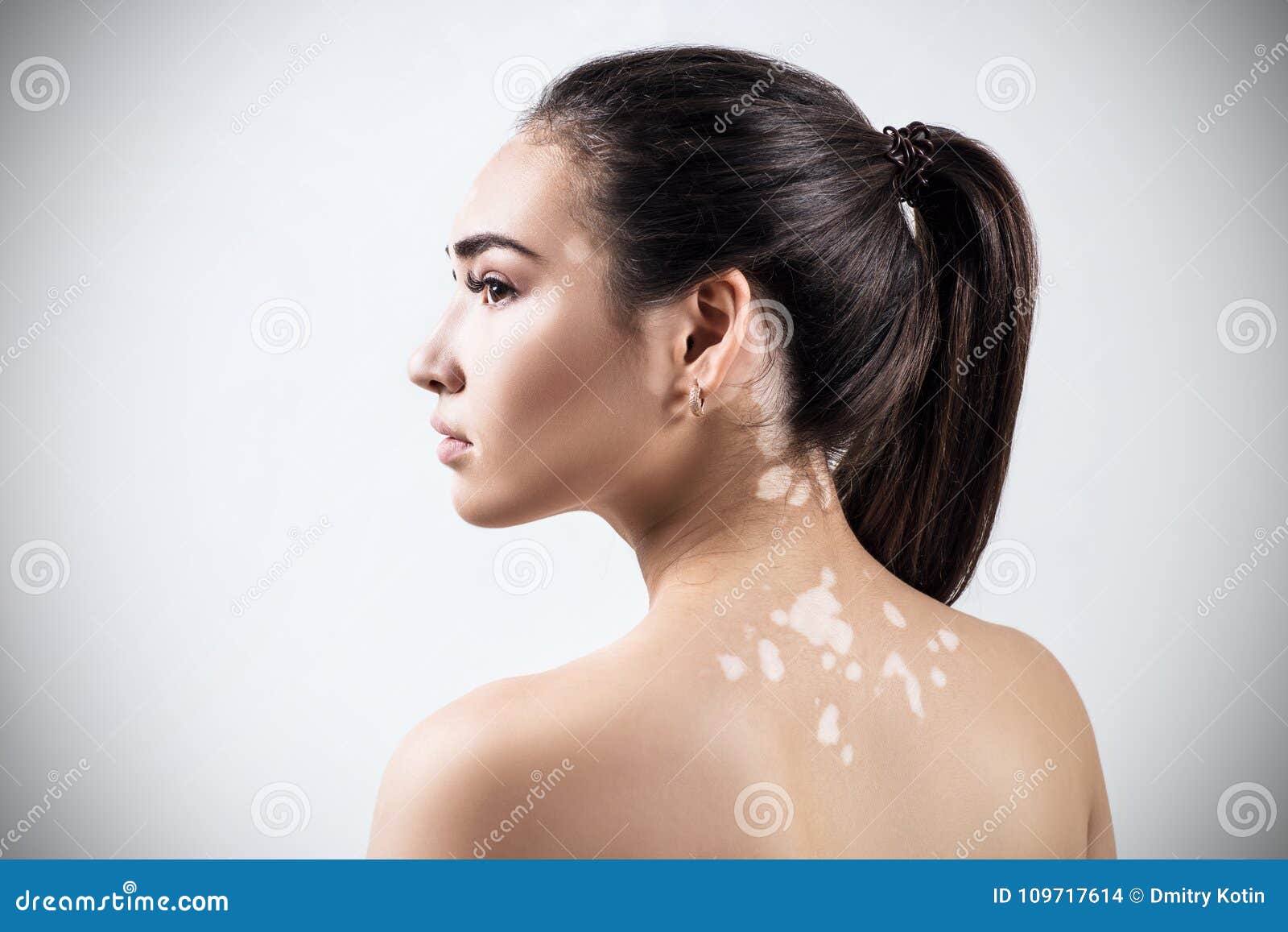 portrait of beautiful woman with vitiligo.