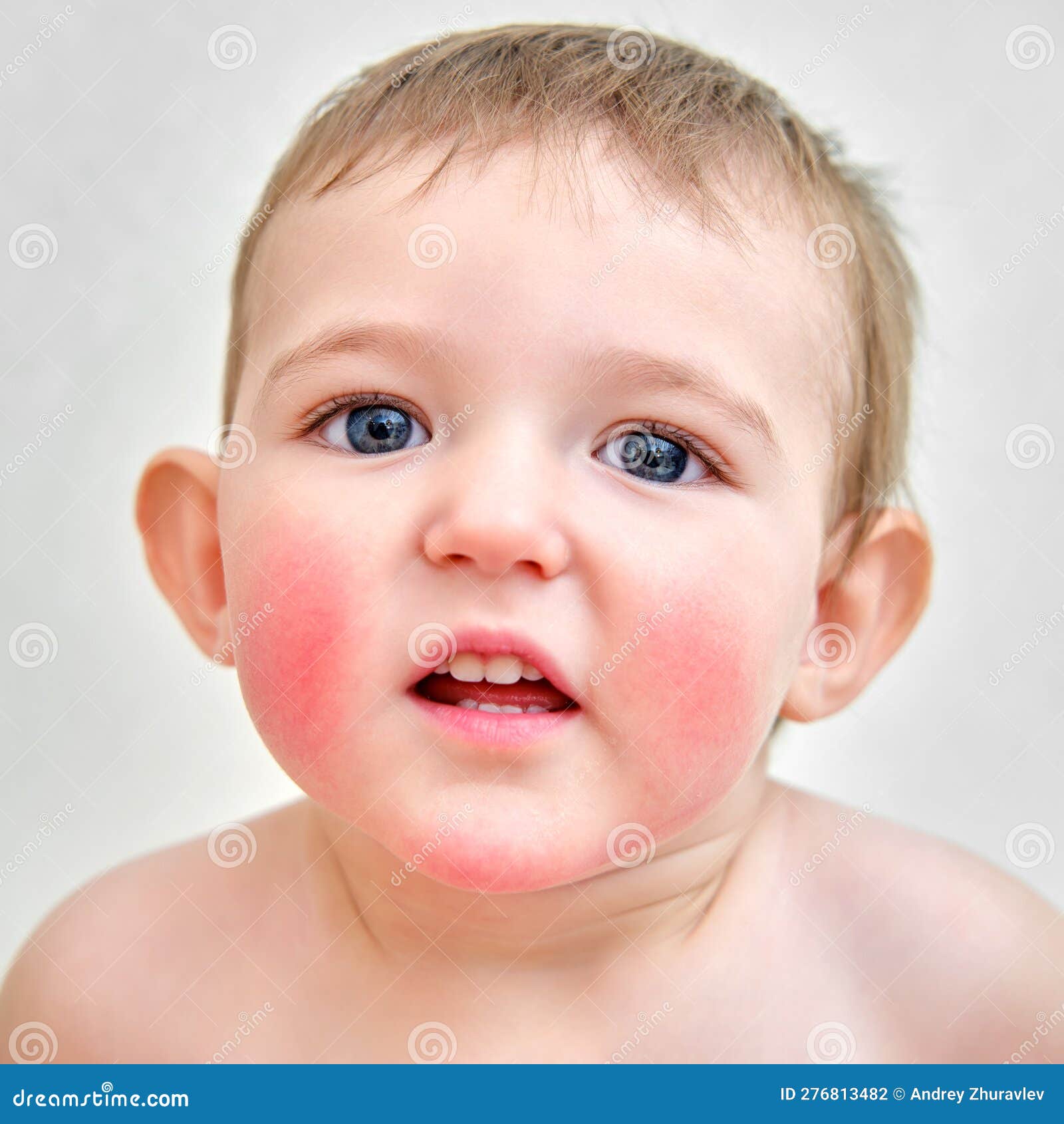 Portrait of a child with allergies on the cheeks and chin. Toddler baby boy with allergies on red face skin, white background-