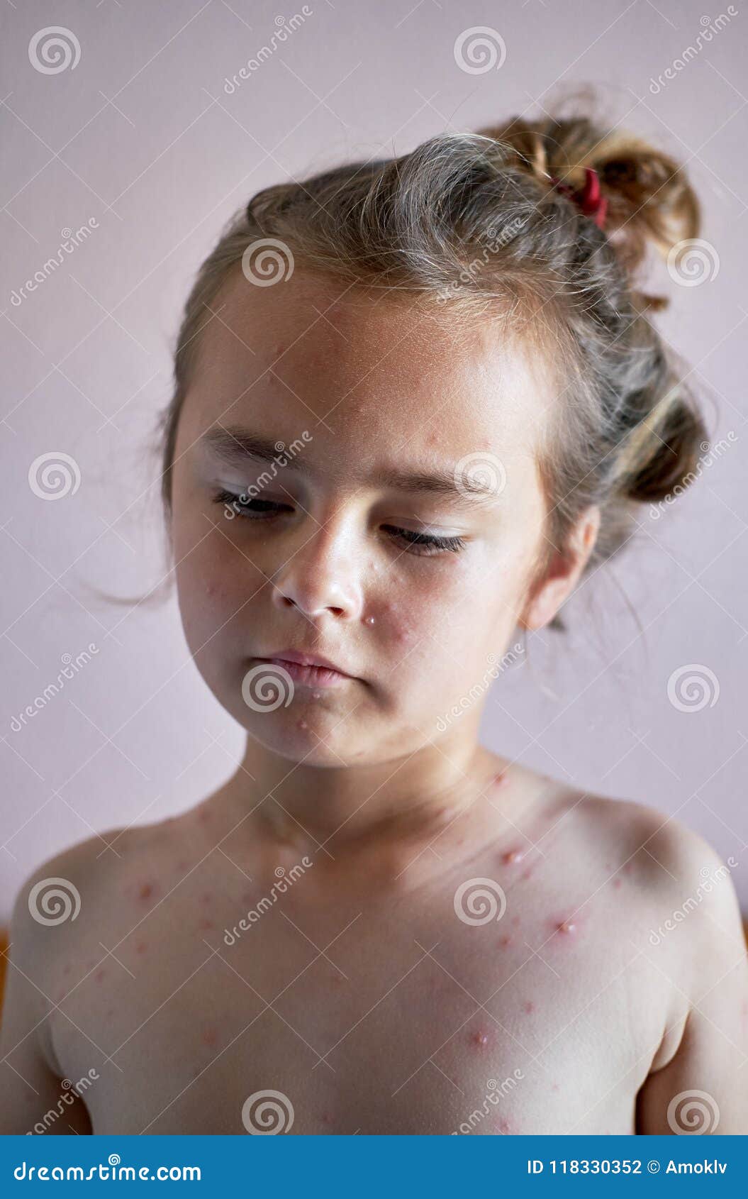  little girl chickenpox Little girl with varicella, chicken pox, small poxの写真素材 ...