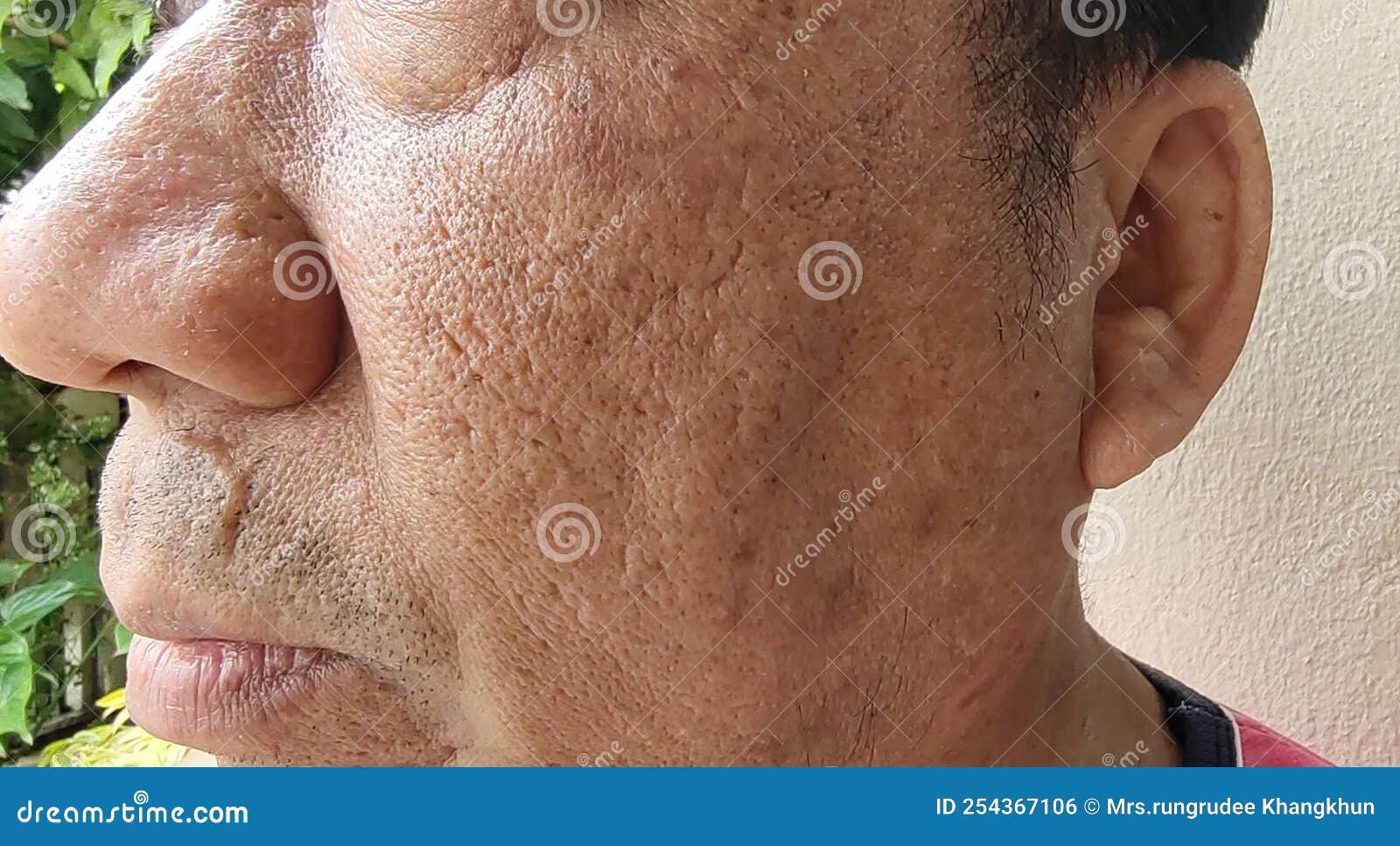 the wrinkled blemish and dark spots, freckles and acne on the face.