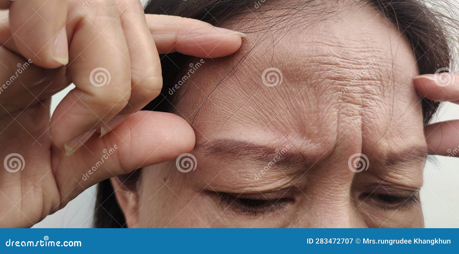 The Flabby Skin Wrinkles And Ptosis Beside The Eyelid Forehead Lines