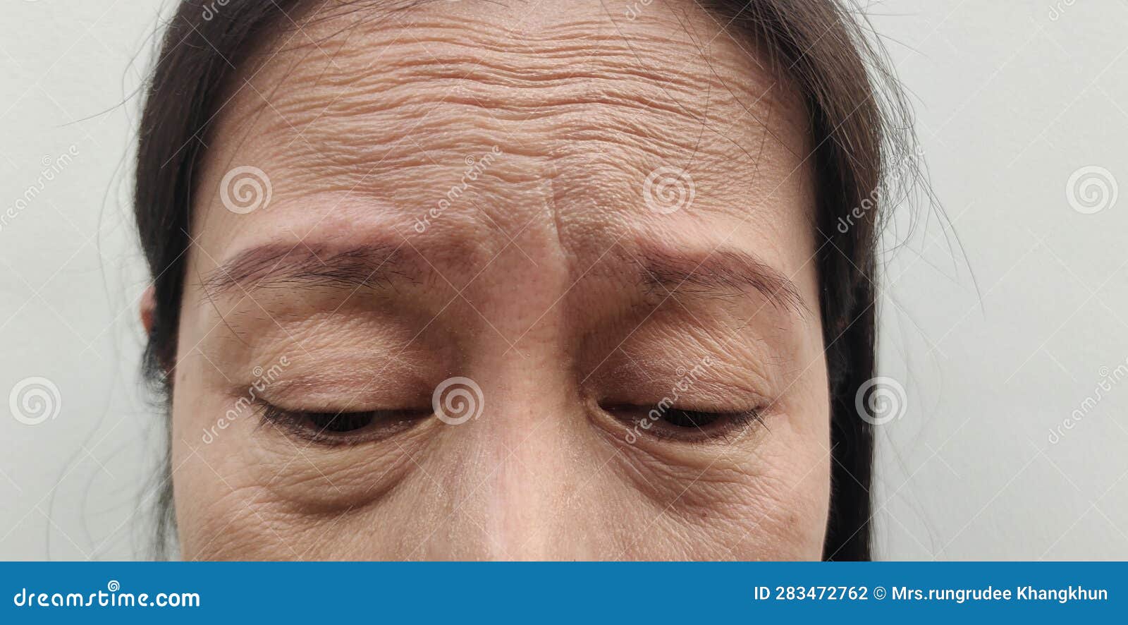 The Flabby Skin Wrinkles And Ptosis Beside The Eyelid Forehead Lines