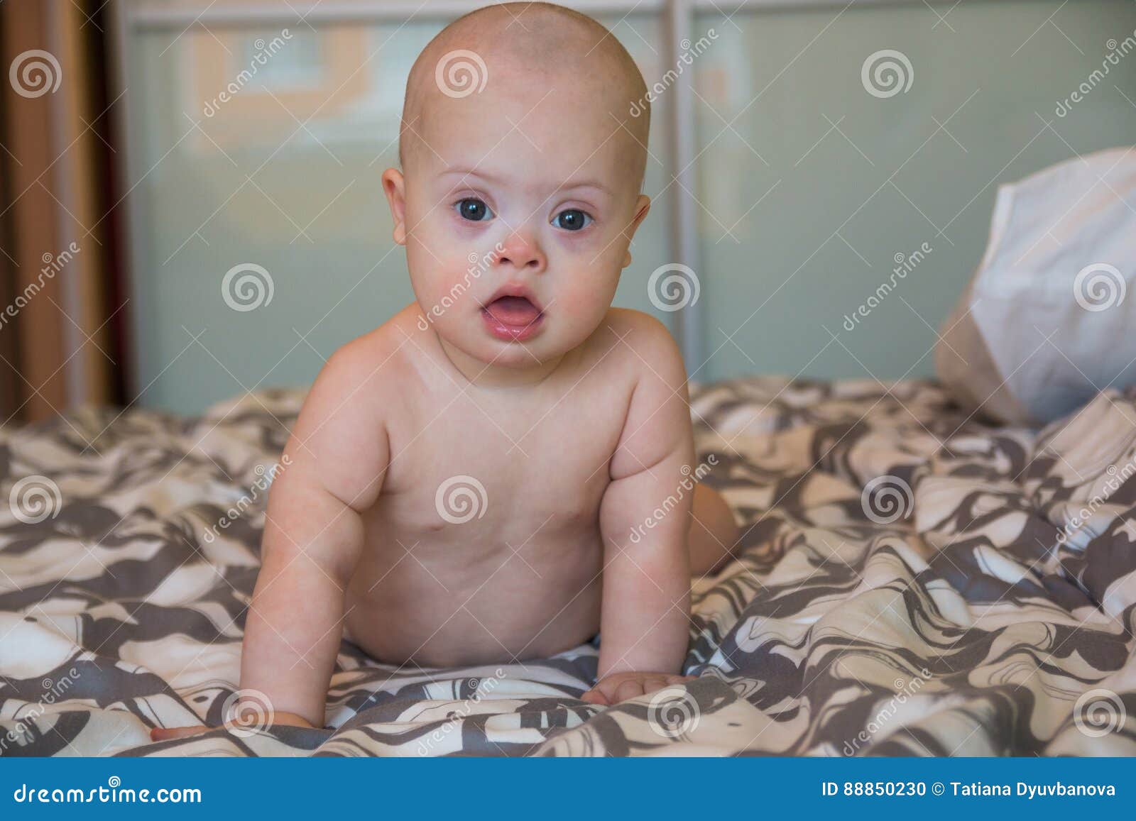 фото новорожденного ребенка с синдромом