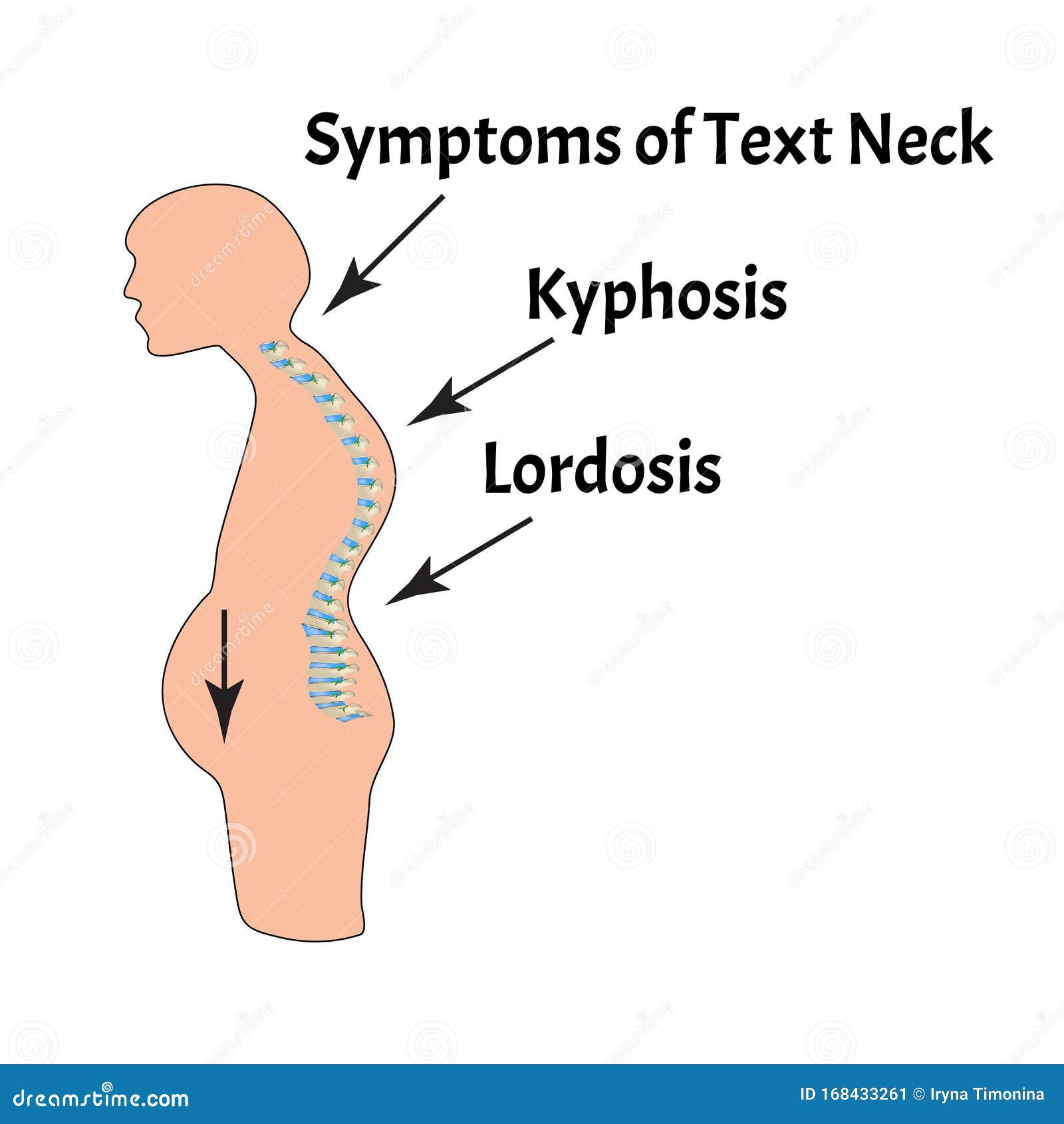 Text Neck Syndrome Spinal Curvature Kyphosis Lordosis Of The Neck