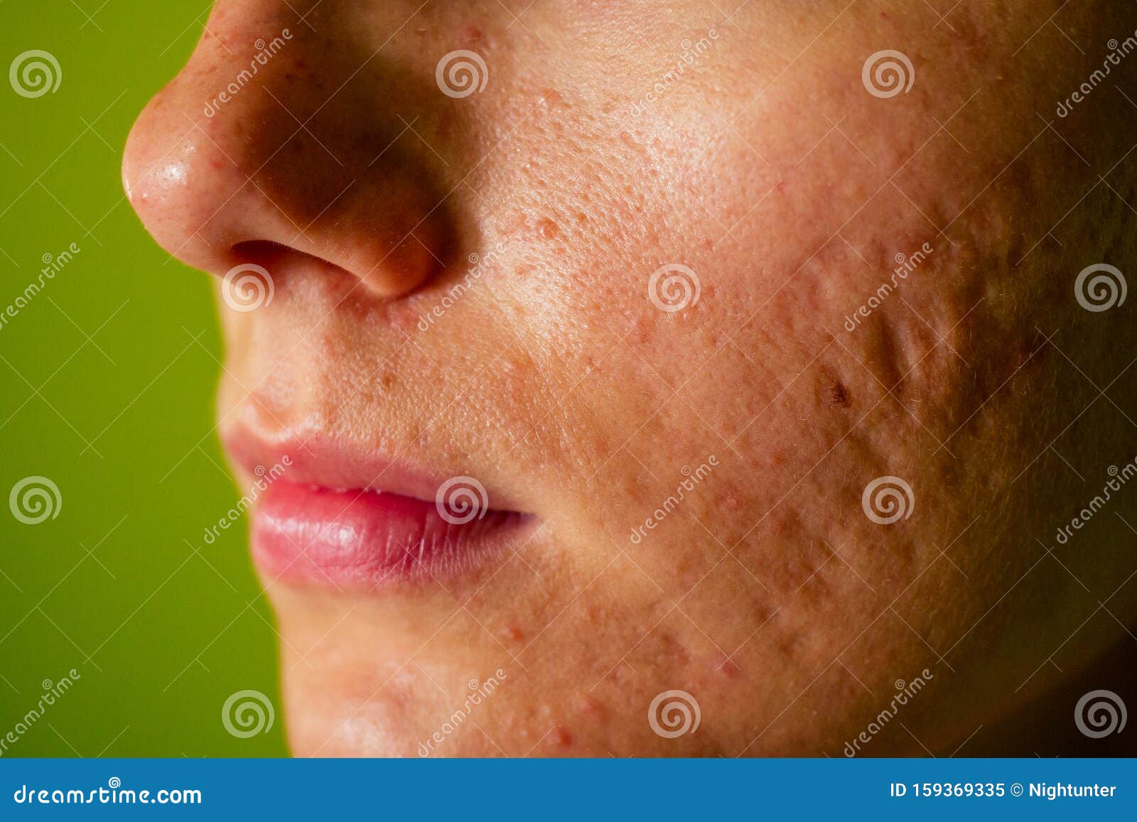 Post-acne, Scars and Festering Pimples on the Face of a Young Woman. Concept of Skin Problems and Harmonic Failure Stock Image - Image of blemishes, overproduction: 159369335