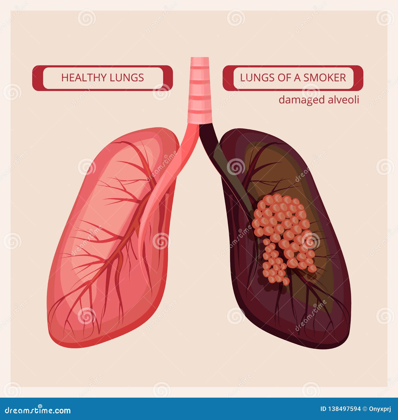 Poumons De Fumeur Images Infographic Medicales De Dommages De Fumee De Poumon De Vecteur Humain De Cancer Illustration De Vecteur Illustration Du Carte Livret