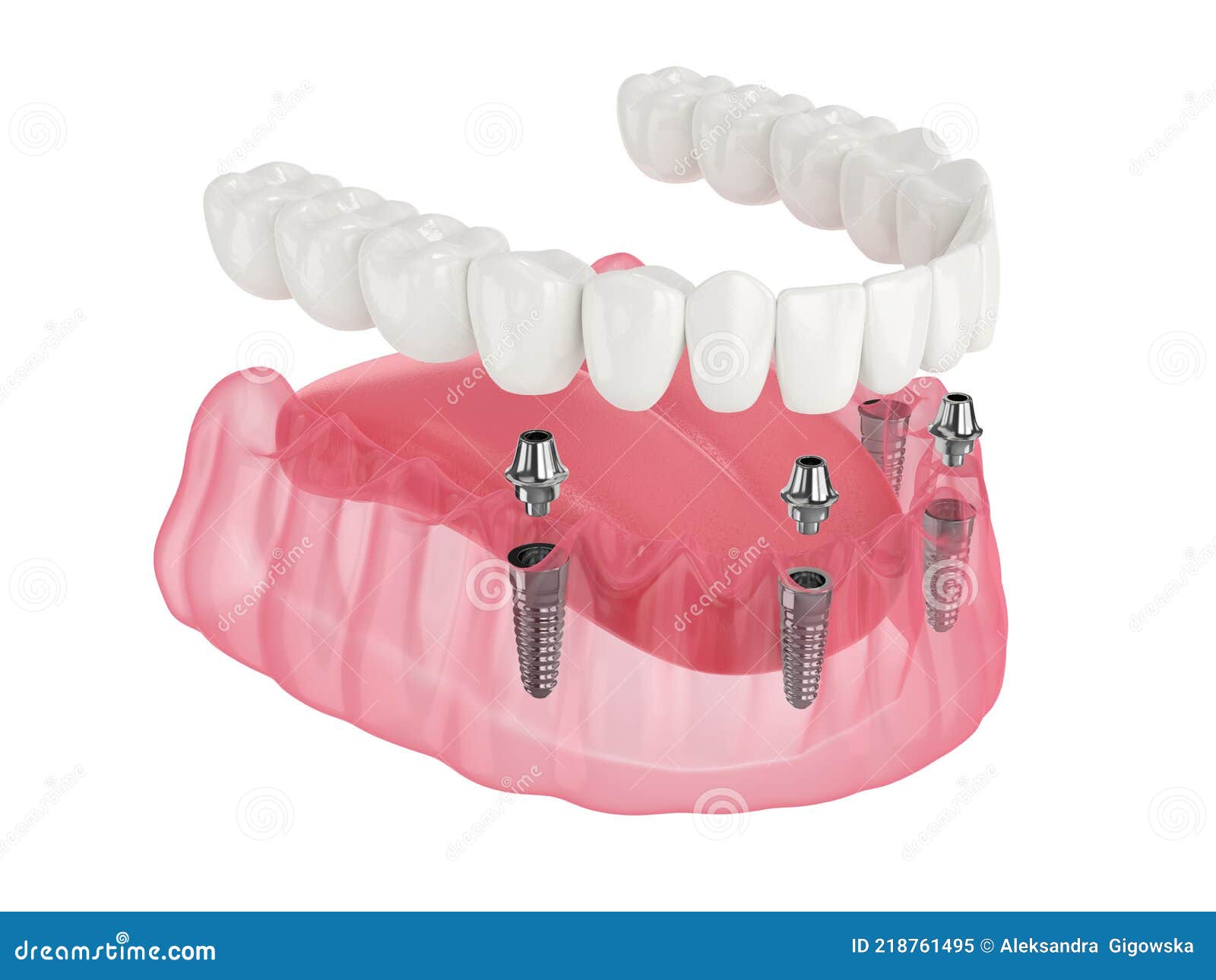 Prótese Mandibular Maxilar Tudo Sobre Sistema Suportado Por, mandibula e  maxilar 