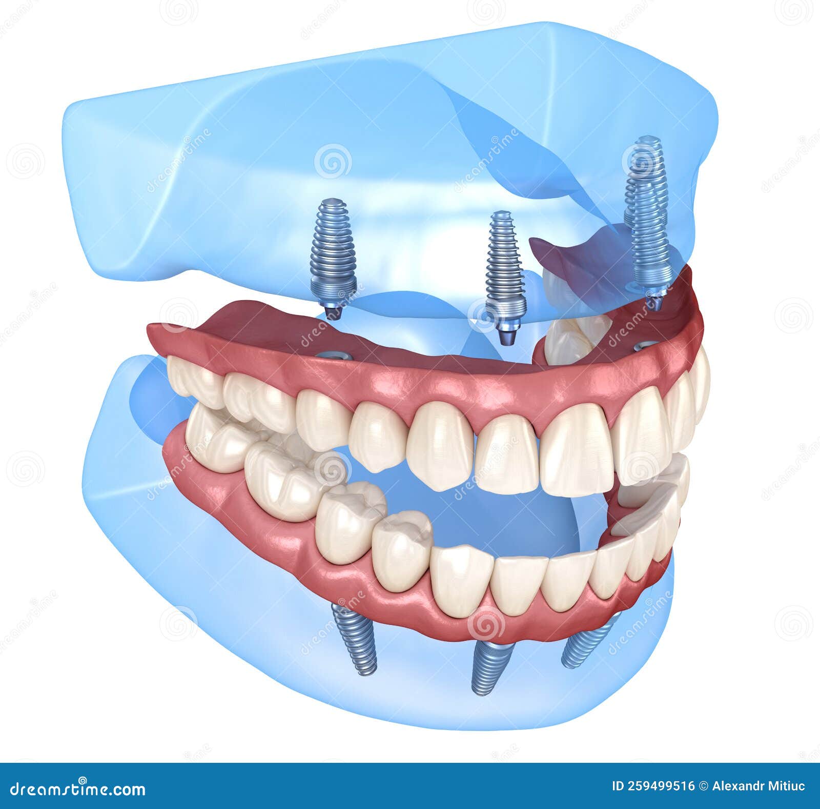 Prótese Mandibular Maxilar Tudo Sobre Sistema Suportado Por, mandibula e  maxilar 