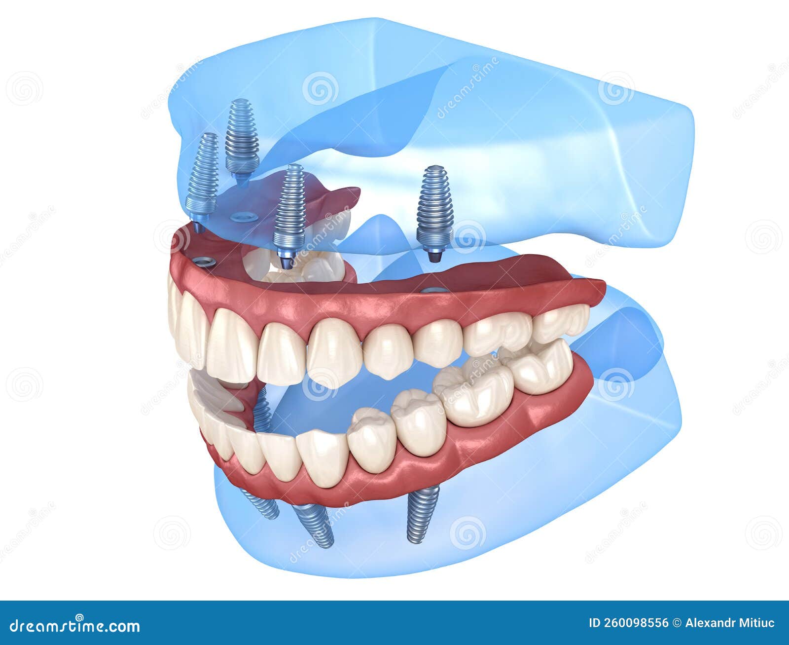 Prótese Maxilar E Mandibular Com Goma No Sistema 4 Apoiada Por