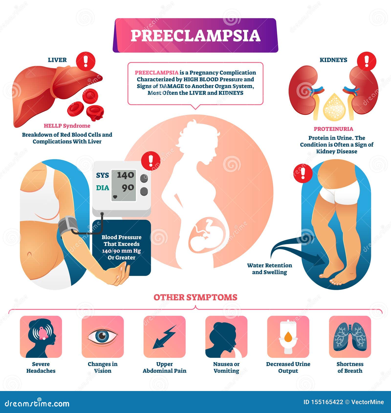 Preeclampsia Vector Illustration 