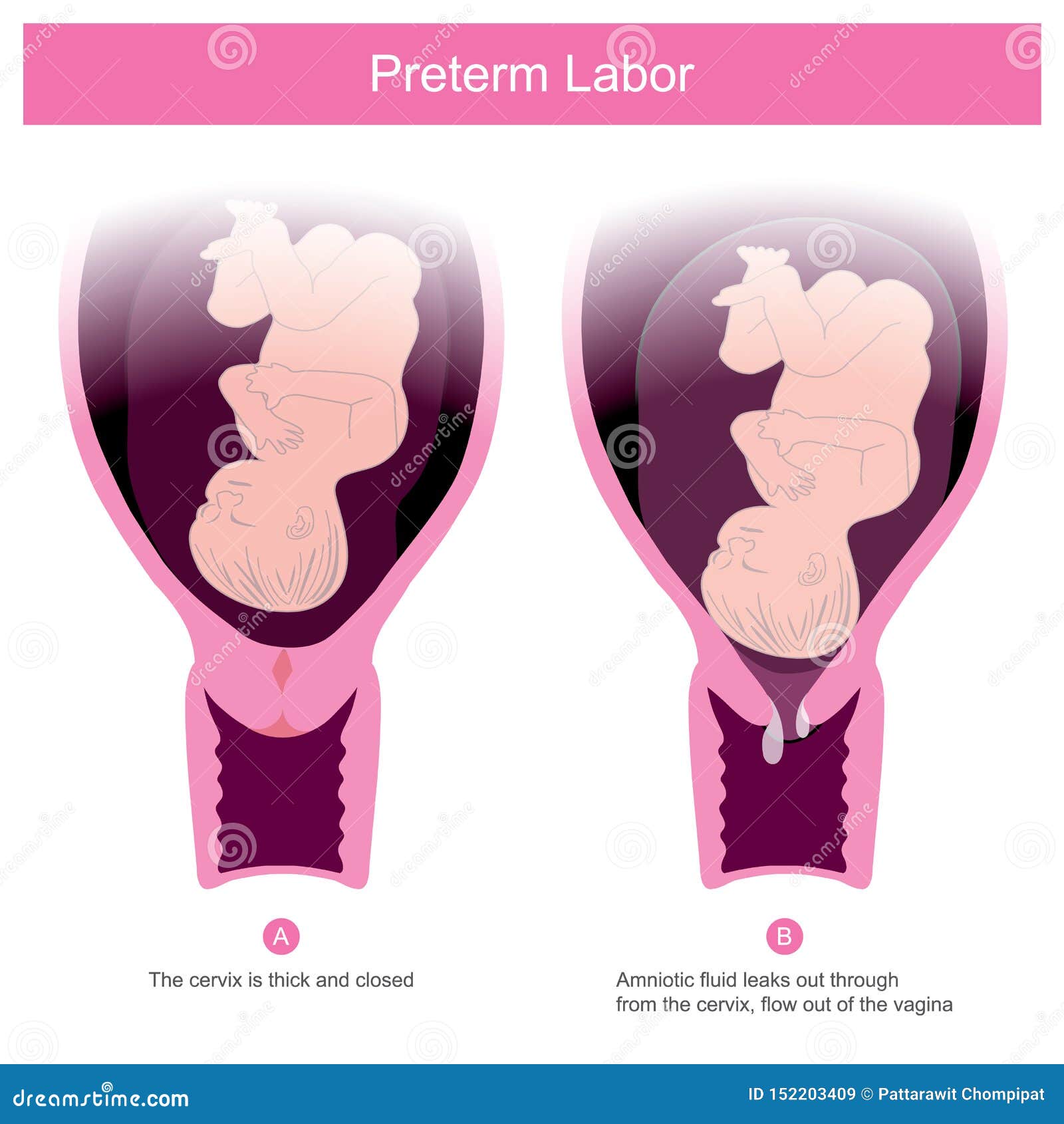 the premature birth, can occur in conditions of amniotic fluid leaks out through the cervix .and flow out of the vagina including