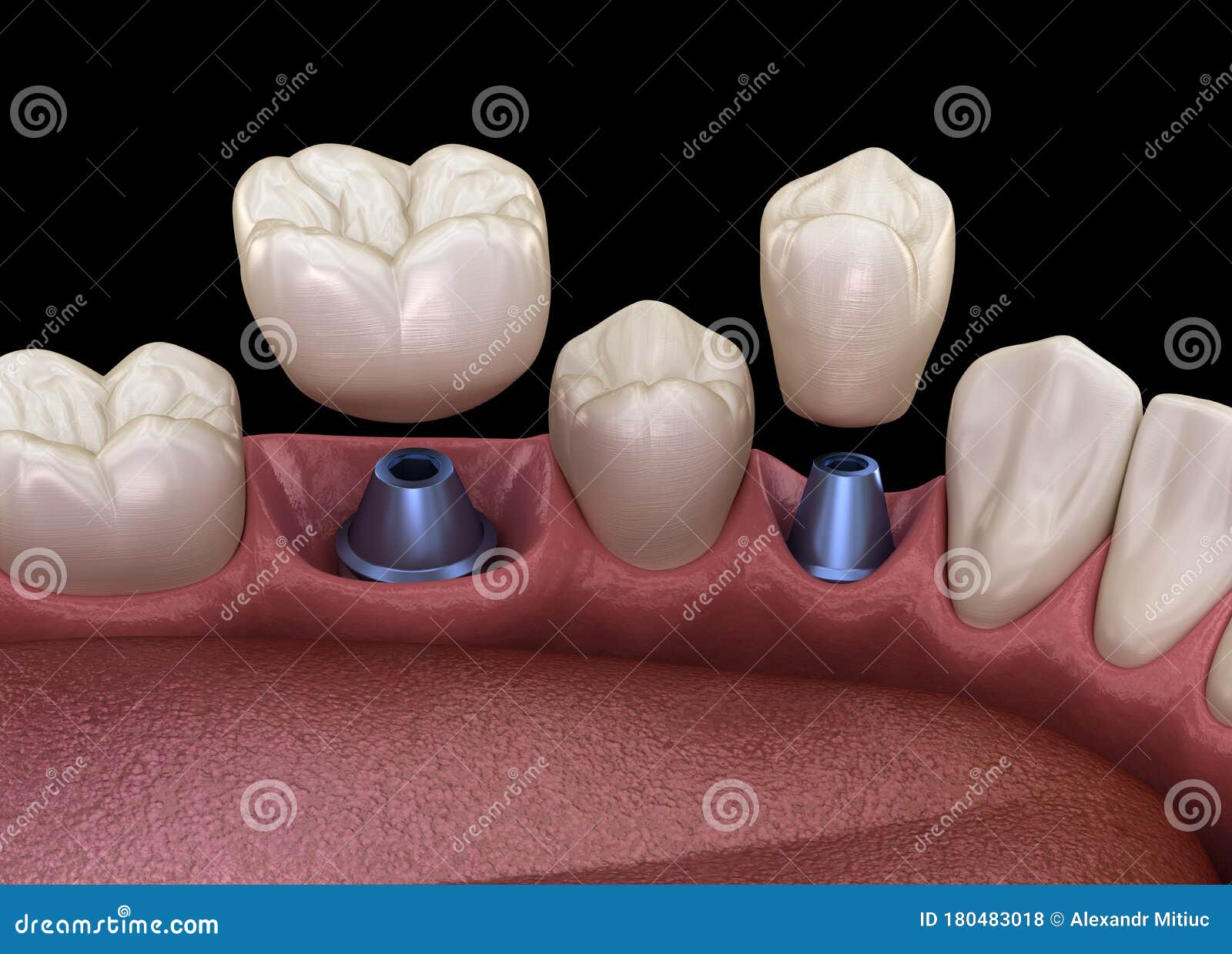 premolar and molar tooth crown installation over implant - concept. 3d  of human teeth