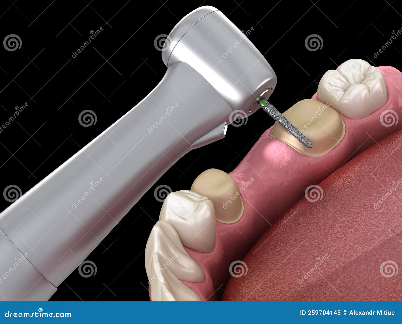 Premolar Preparation Process for Dental Crown Placement. Medically