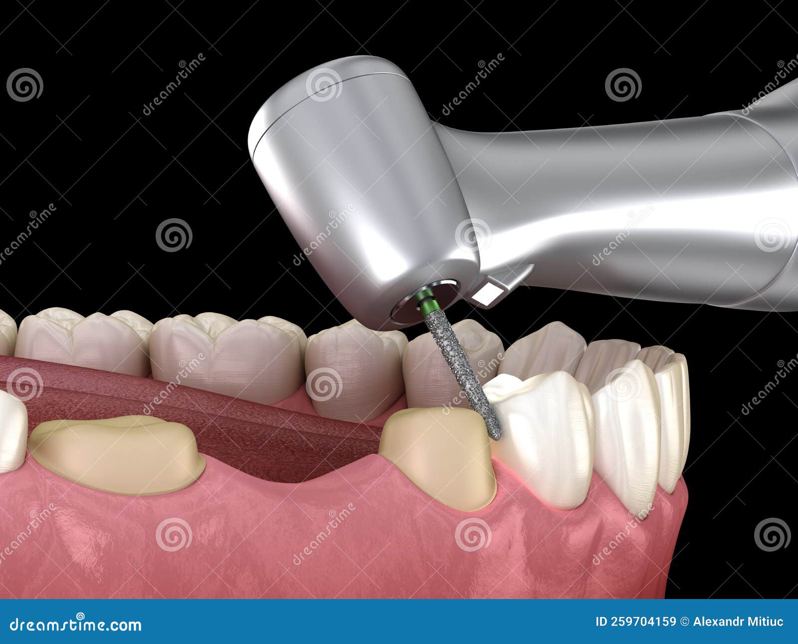 Premolar Preparation Process for Dental Crown Placement. Medically