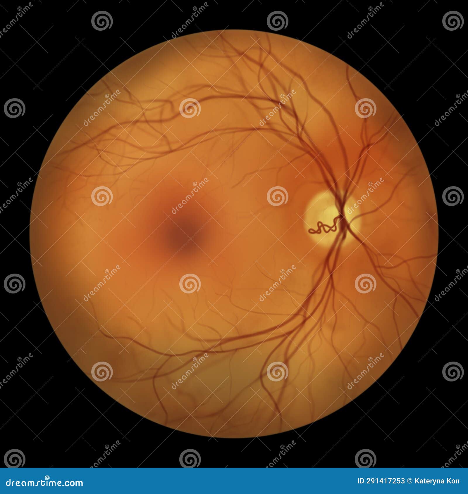 a prepapillary vascular loop on the retina, 