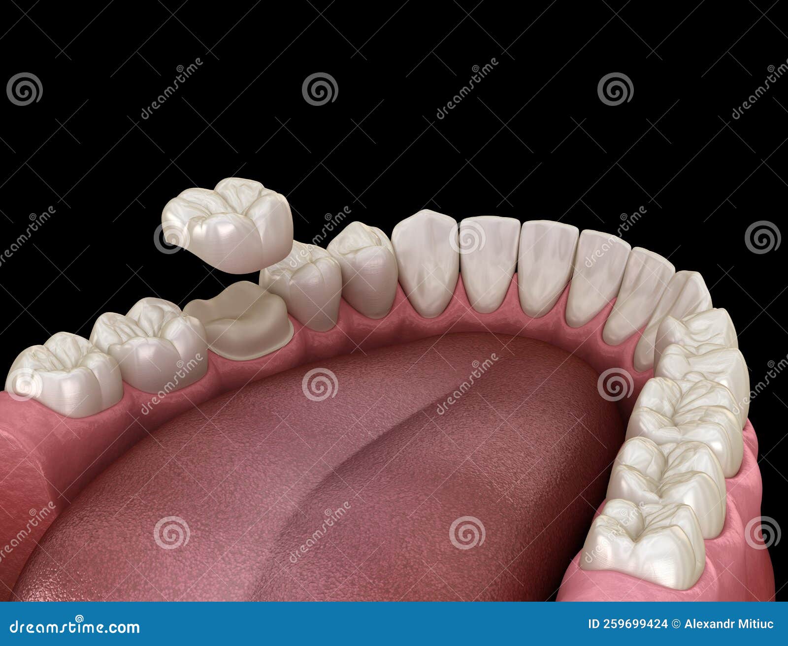 Preparated Molar Tooth for Dental Crown Placement. Medically Accurate