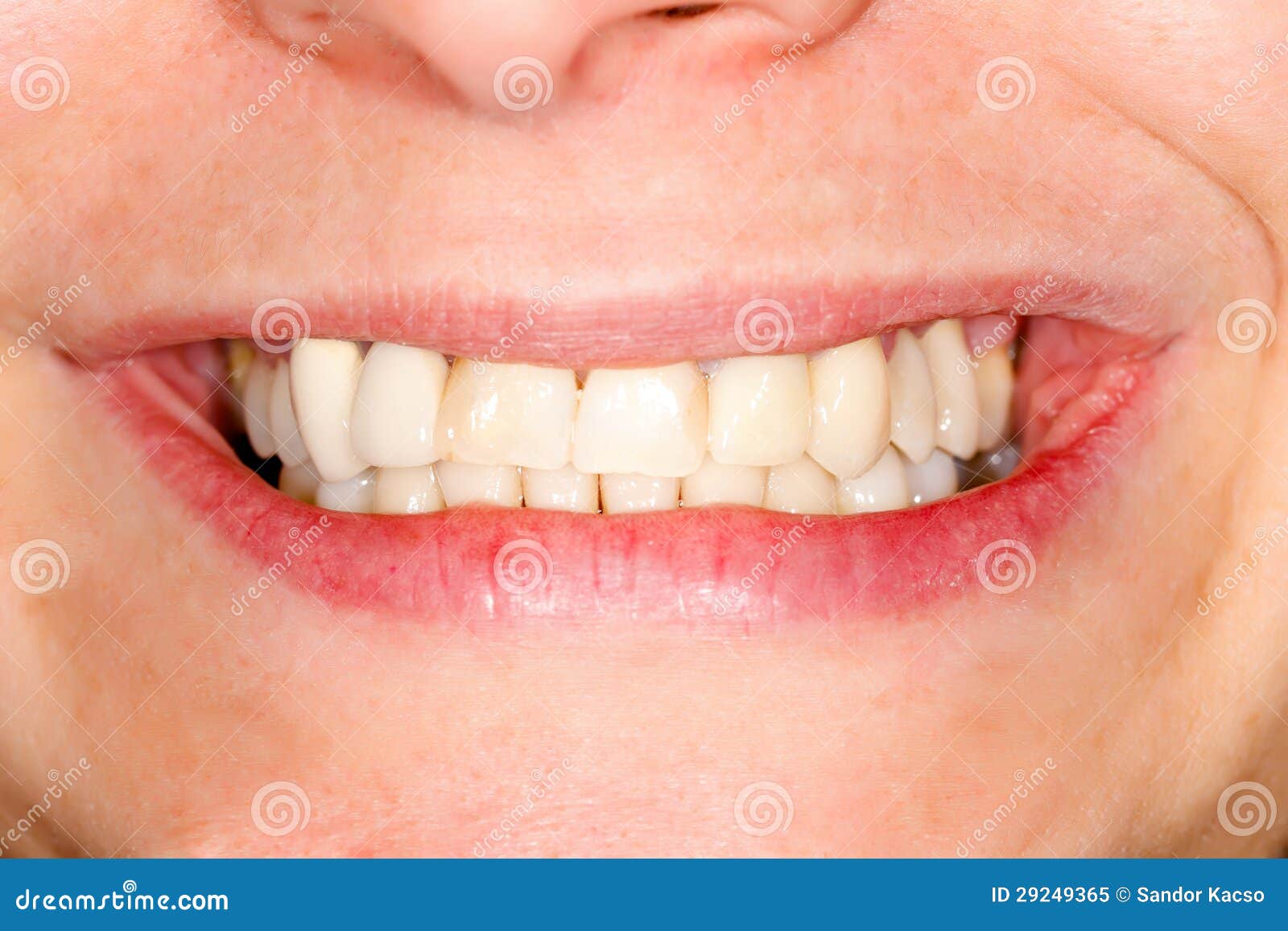 Pressed ceramic teeth stock image. Image of dentist, denture 29249365
