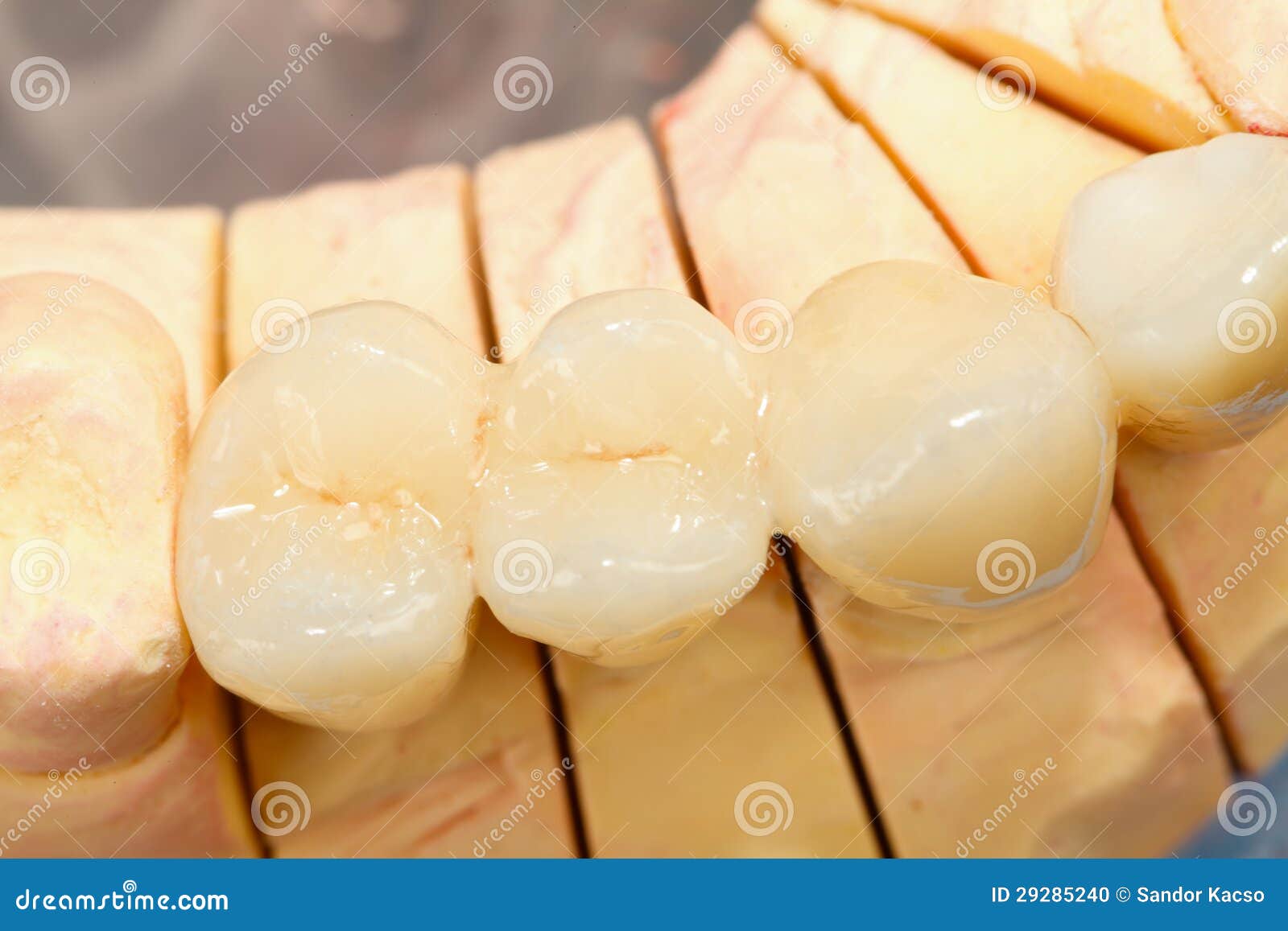 Pressed ceramic teeth stock photo. Image of dental, prosthesis 29285240