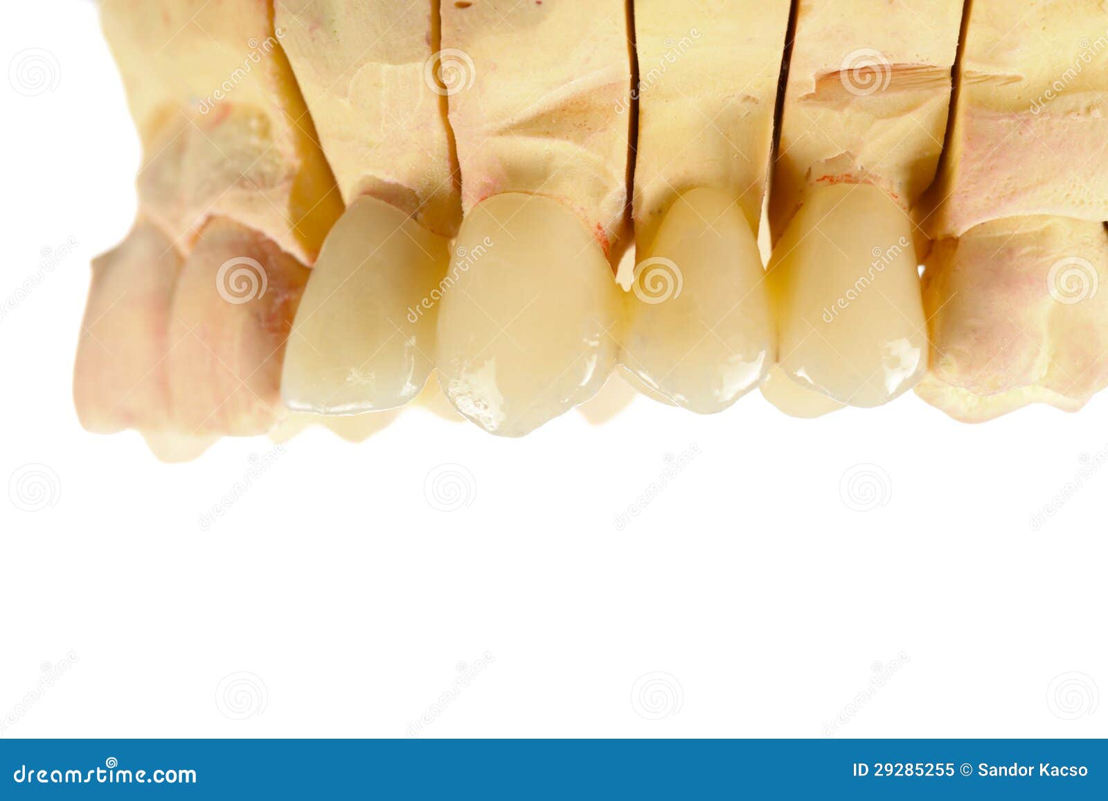 Pressed ceramic teeth stock image. Image of prosthetic 29285255