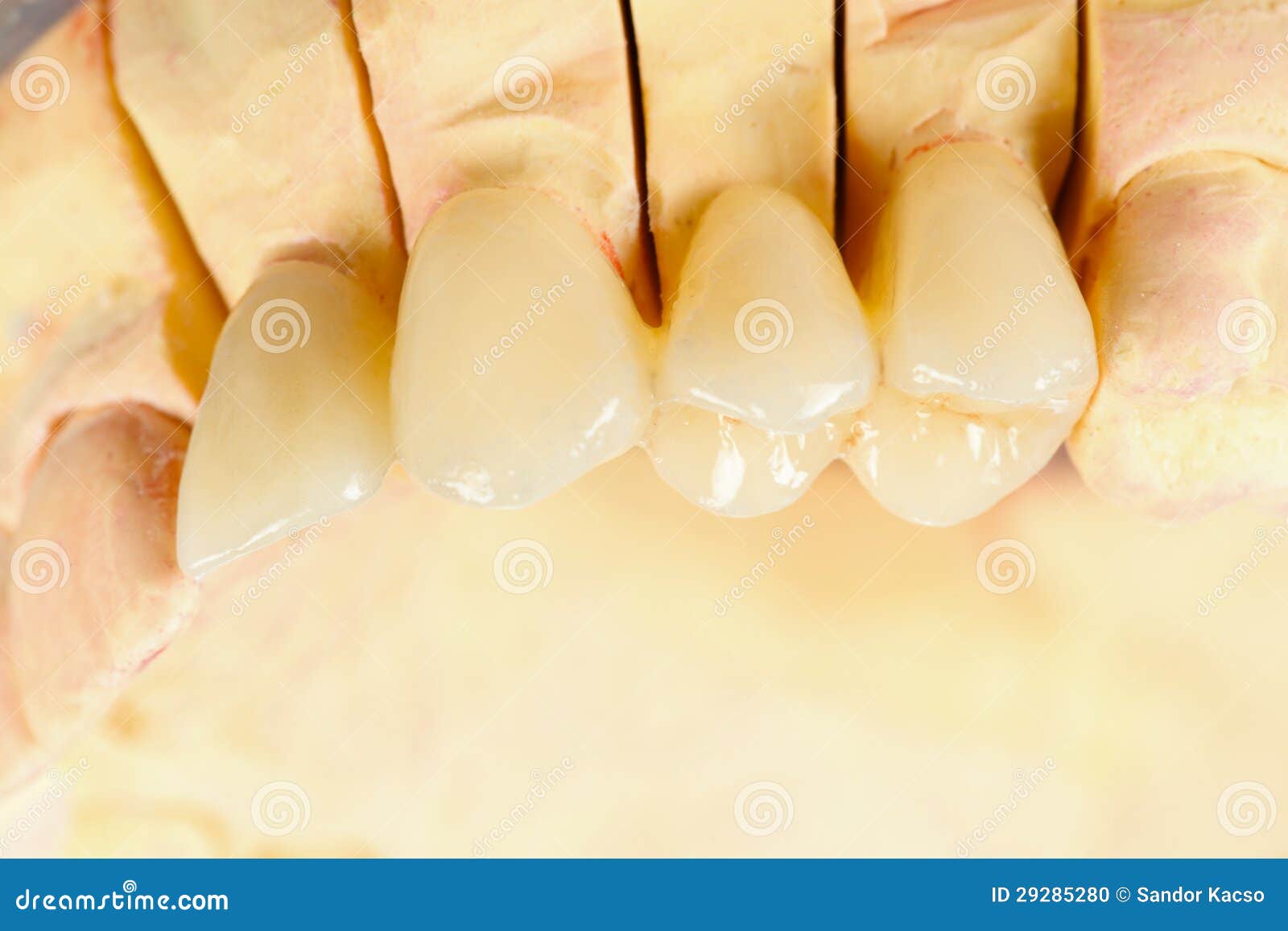 Pressed ceramic teeth stock photo. Image of healthcare 29285280