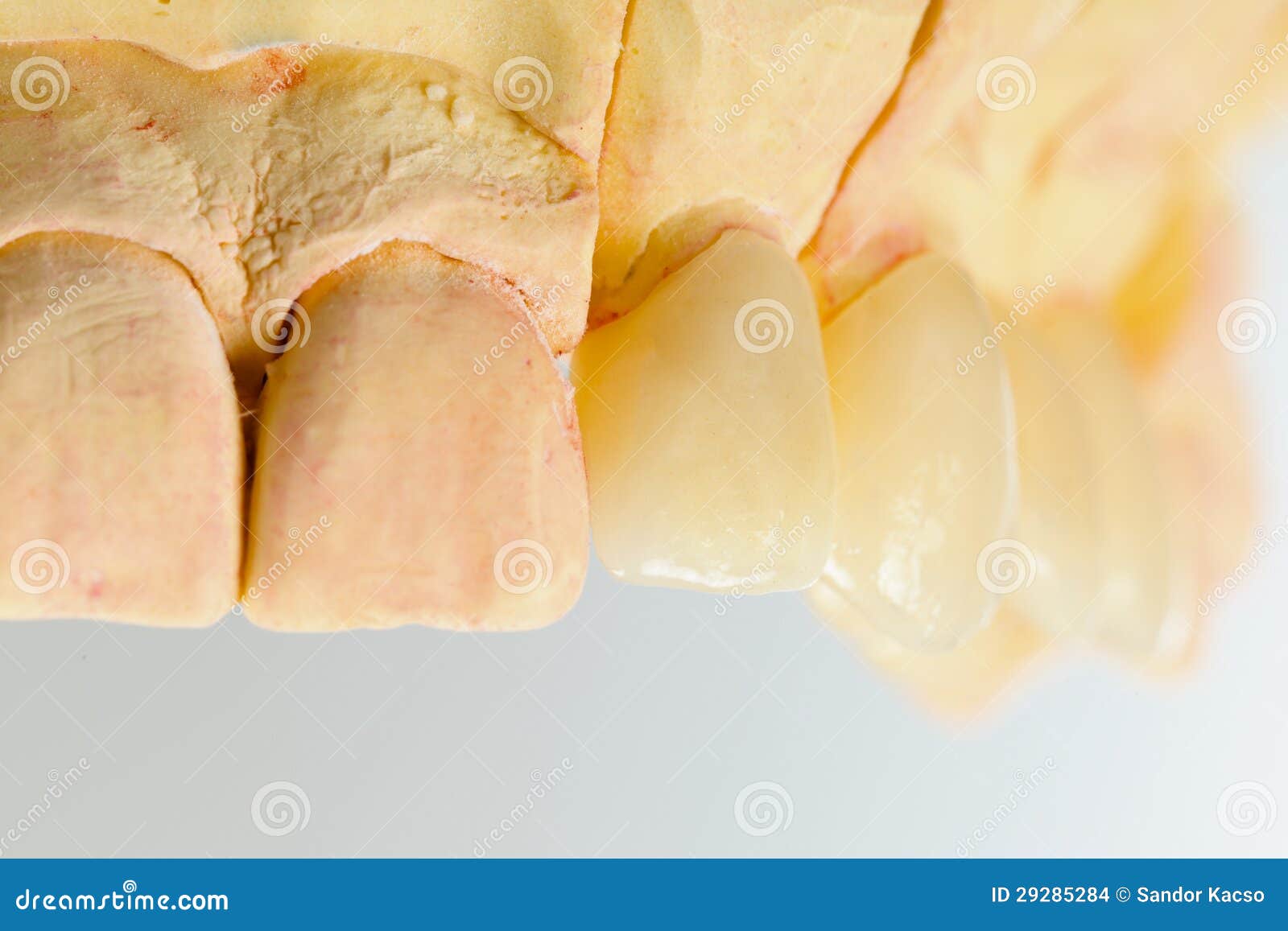 Pressed ceramic teeth stock photo. Image of teeth, mouth 29285284